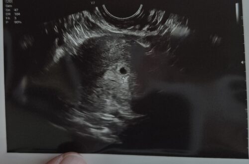 [임신일기-03] 아기집 집들이하러 병원에 방문하다. (4-5주차, 쓰리라인임테기, 동탄제일병원, 임신확인서) 임신일기3 2