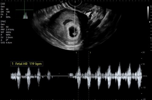 [임신일기-04] 울컥했던 심장소리 듣기, 젤리곰 너무 귀여워 (6-8주차, 입덧 시작, 임신초기 해외여행, 갑상선 수치, 태명 짓기) 임신일기4 002